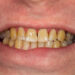credit: hovedentalclinic.co.uk



human teeth after smoking. Brown resinous plaque on teeth close-up. Smoking harm concept