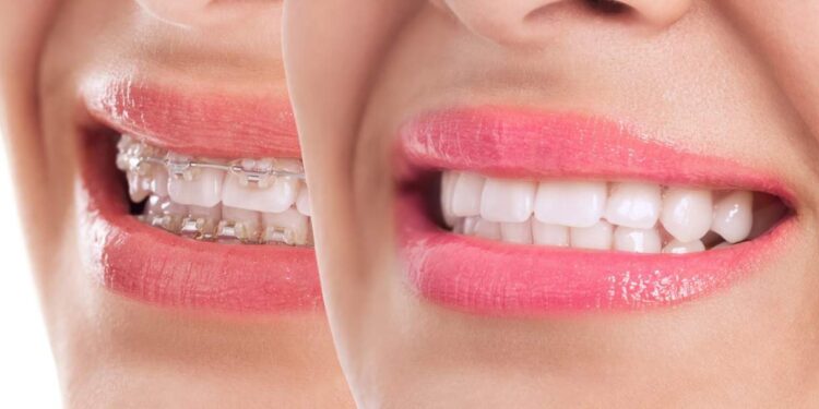 Can You Whiten Teeth With Braces A Comprehensive Guide Bm 