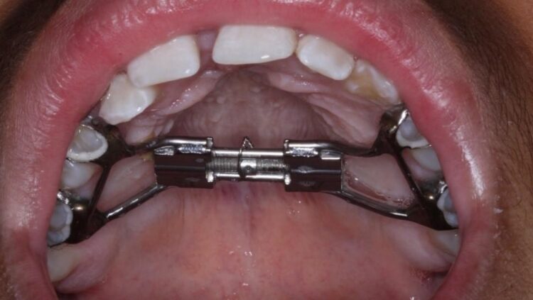 Marcel Expanders How To Turn An Expander For Teeth? Step By Step Guidance - Brussels ...