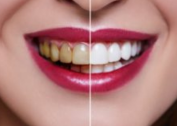 Can Yellow Teeth Be Whitened