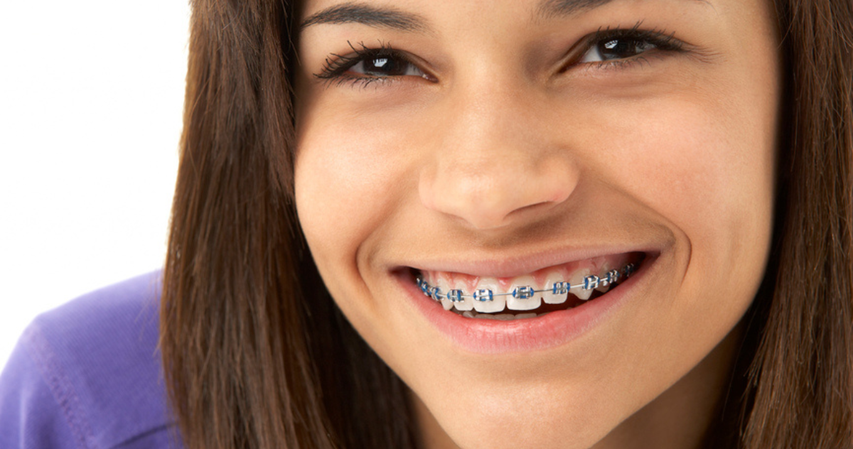 Do Braces Stain Your Teeth