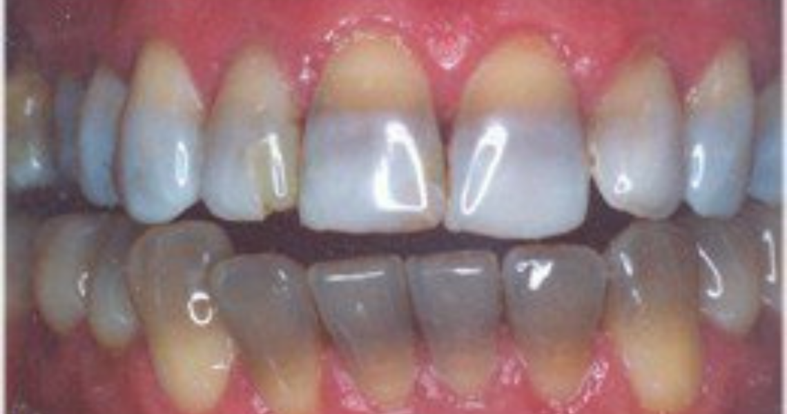 Why Are My Teeth Blue? 6 Reasons For It - Brussels Morning Newspaper