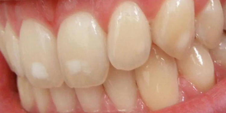 How To Remove Calcium Deposits On Teeth