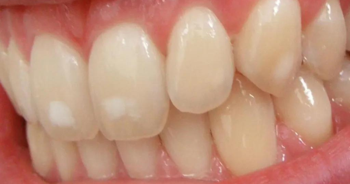 How To Remove Calcium Deposits On Teeth