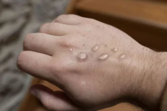 Belgium health officials prepare for Mpox spread amid outbreaks