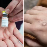 Belgium prepares for Mpox response amid global health emergency