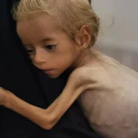 Gaza health ministry reports 100 children died of malnutrition