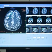 Leuven's REMYND develops REM0046127 A new hope for Alzheimer's treatment