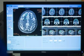 Leuven's REMYND develops REM0046127 A new hope for Alzheimer's treatment