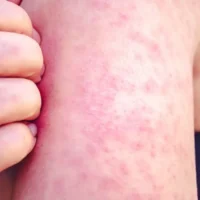 Measles cases rise in Antwerp with 47 reported in April 2025