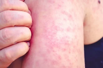 Measles cases rise in Antwerp with 47 reported in April 2025