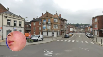 Measles outbreak hits 24 in Limburg, kids under 10 at risk