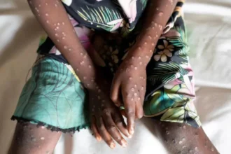 Mpox outbreak in Africa WHO declares emergency